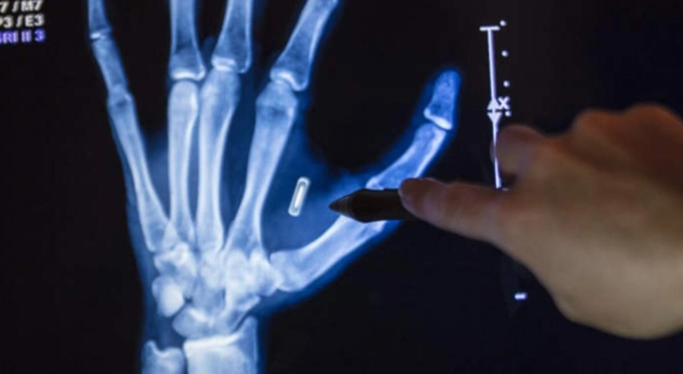 Μάγος εμφύτευσε τσιπάκι στην παλάμη του και ξέχασε τον κωδικό του