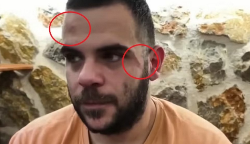 Ξυλοκόπησαν άγρια τον Youtuber Teosty σε live στα Γιάννενα: Τον χτύπησαν σε σώμα και πρόσωπο, εμφανίστηκε με μελανιές (ΒΙΝΤΕΟ)